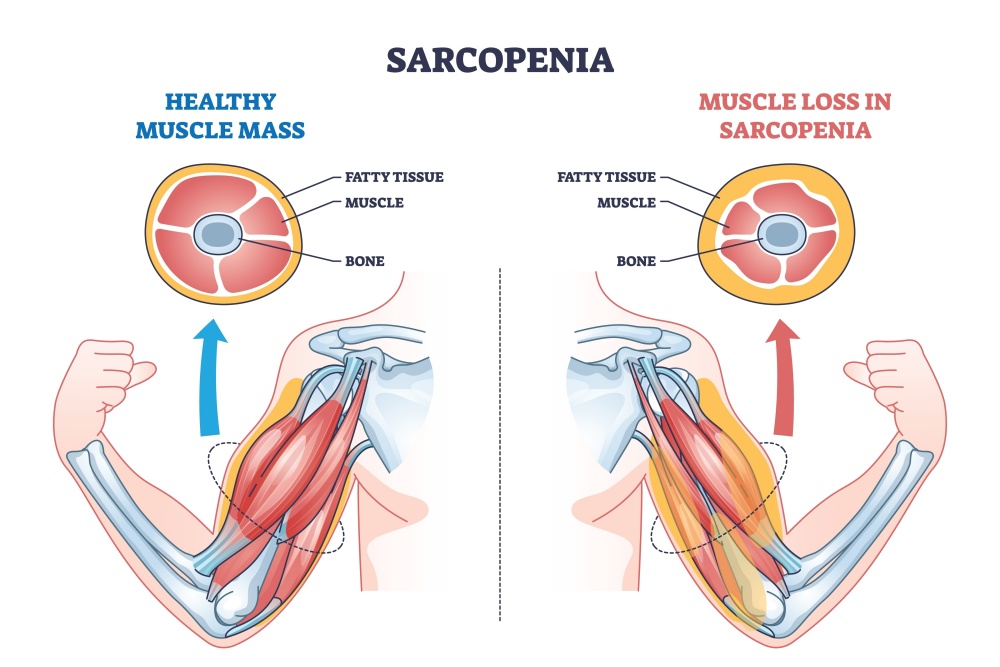 vector image of muscle with sarcopenia